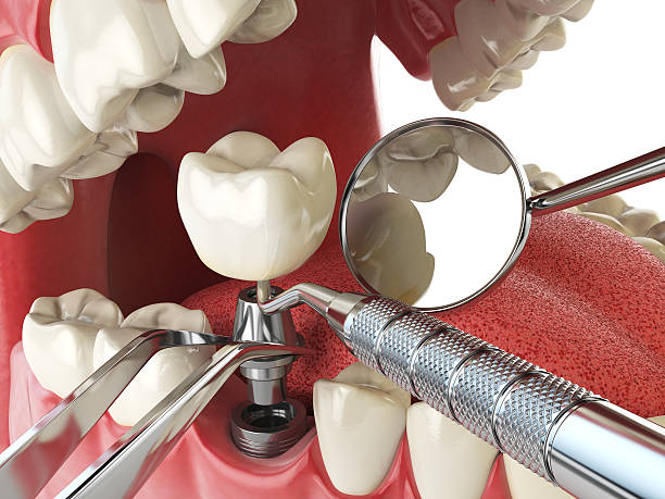Best Emergency Treatment for Dental Infections or Abscesses in Parker, SC